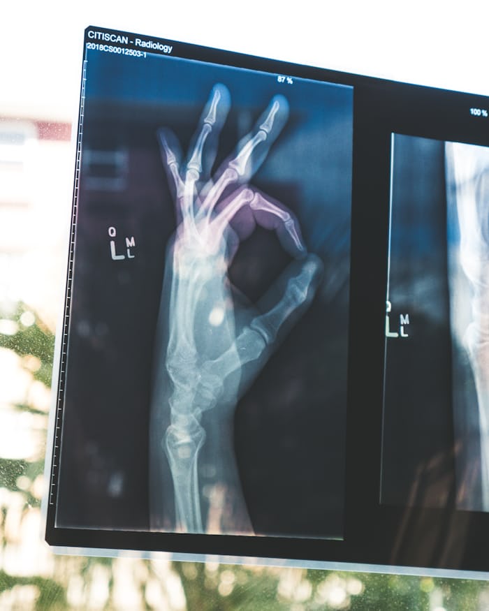 Hand holding a CT scan film up to the light, understanding your MRI report
